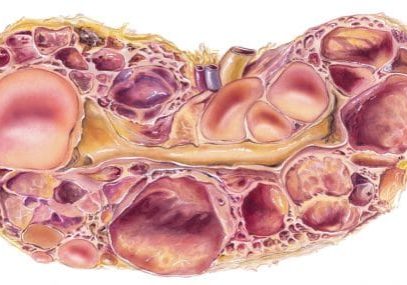 ADPKD
