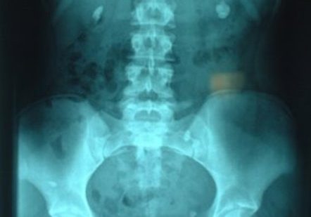 An X-ray showing the pelvis, ribcage and and two clear dots either side of the spine with are kidney stones.
